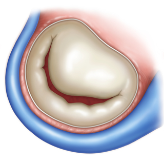 Die Skizze zeigt einen vergrößerten Mitralklappenanulus (Mitralklappenring) vor der Implantation der Metall-Spange Carillon Mitral Contour System ®.