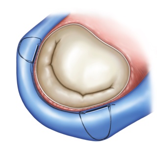 Die Skizze zeigt den Mitralklappenanulus (Mitralklappenring) nach der Implantation der Metall-Spange Carillon Mitral Contour System ®.